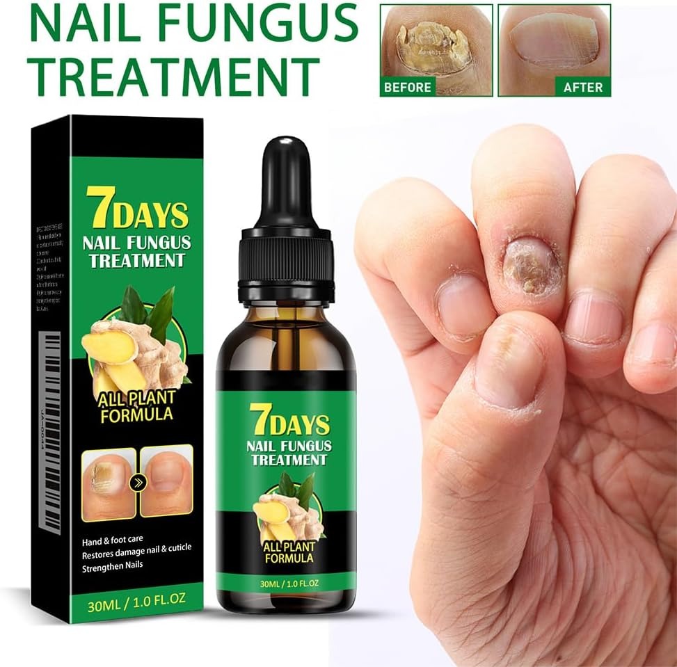 علاج فطريات الأظافر